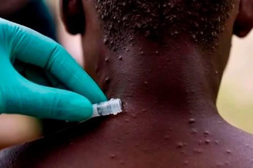 Reportan dos casos de viruela símica en el Edoméx